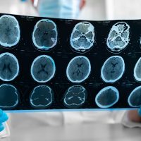 What Is the Role of a Life Care Planner in a Brain Injury Case